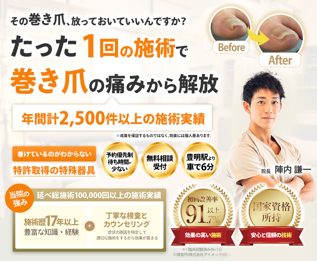 巻き爪施術